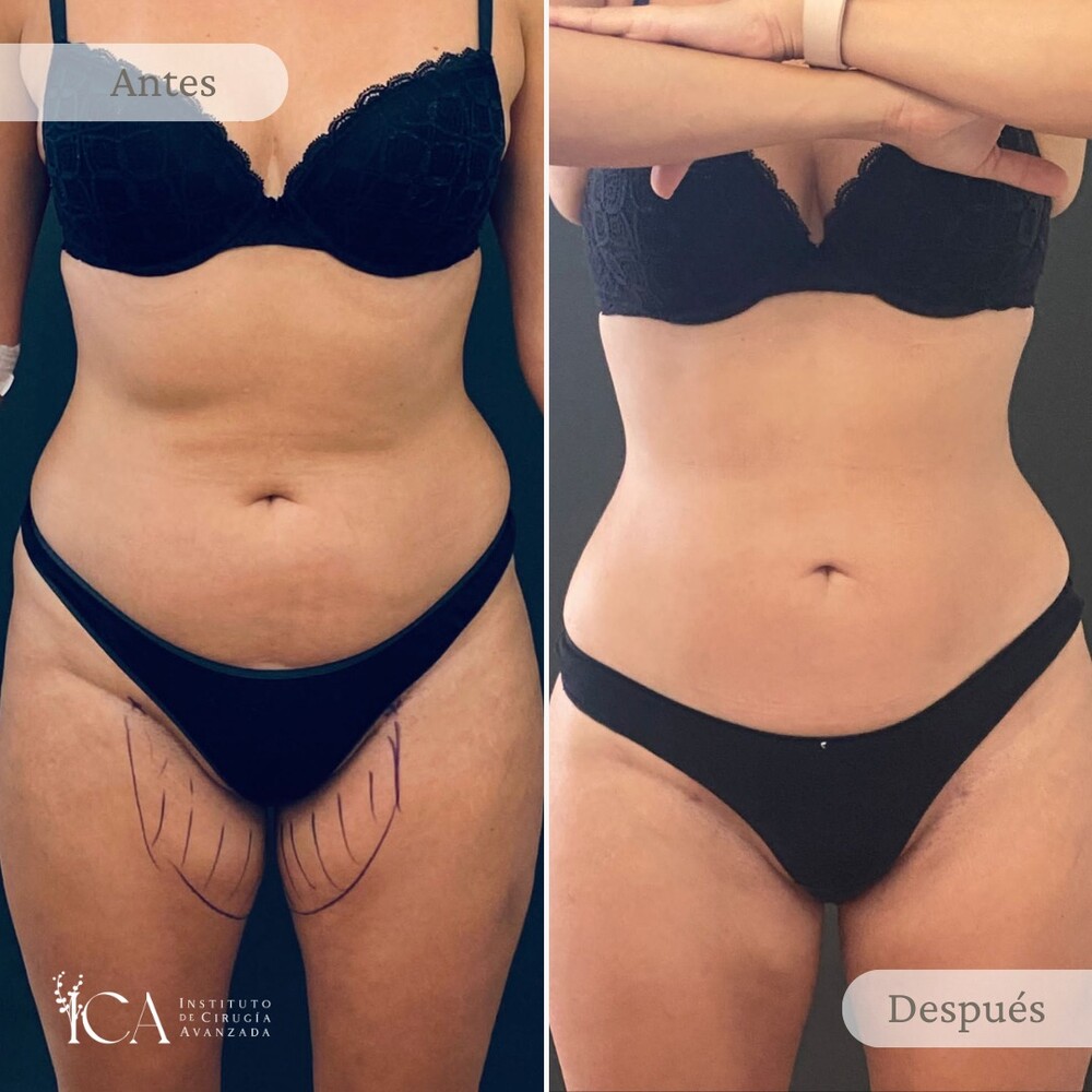 Before and After Result